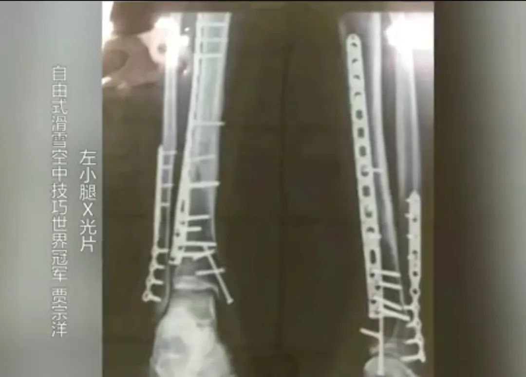 賈宗洋個人資料簡介 賈宗洋身上有多少鋼釘 賈宗洋個人資料簡介 賈宗洋身上有多少鋼釘